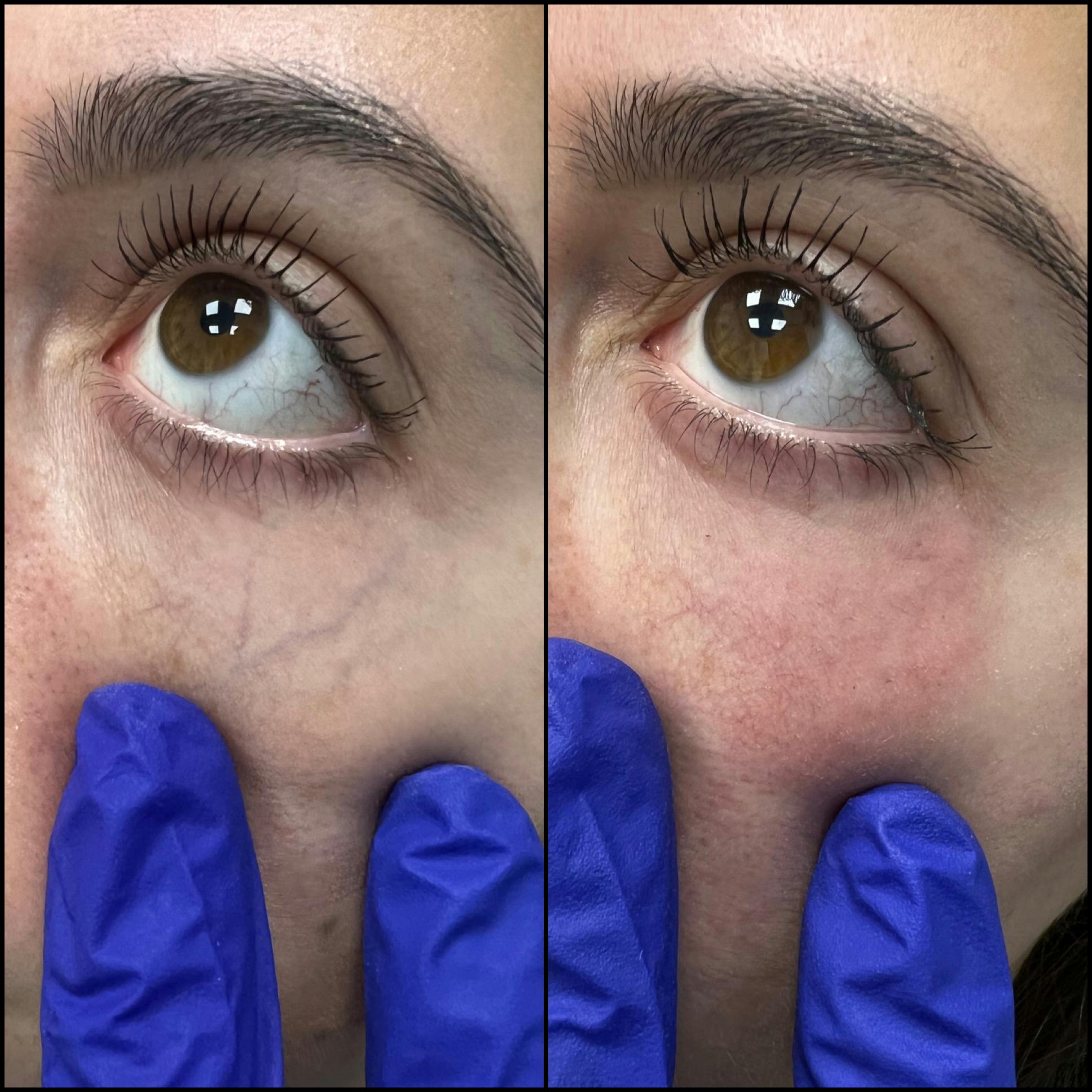 Under Eye Vein Treatment Before & After Gallery - Patient 122771106 - Image 1