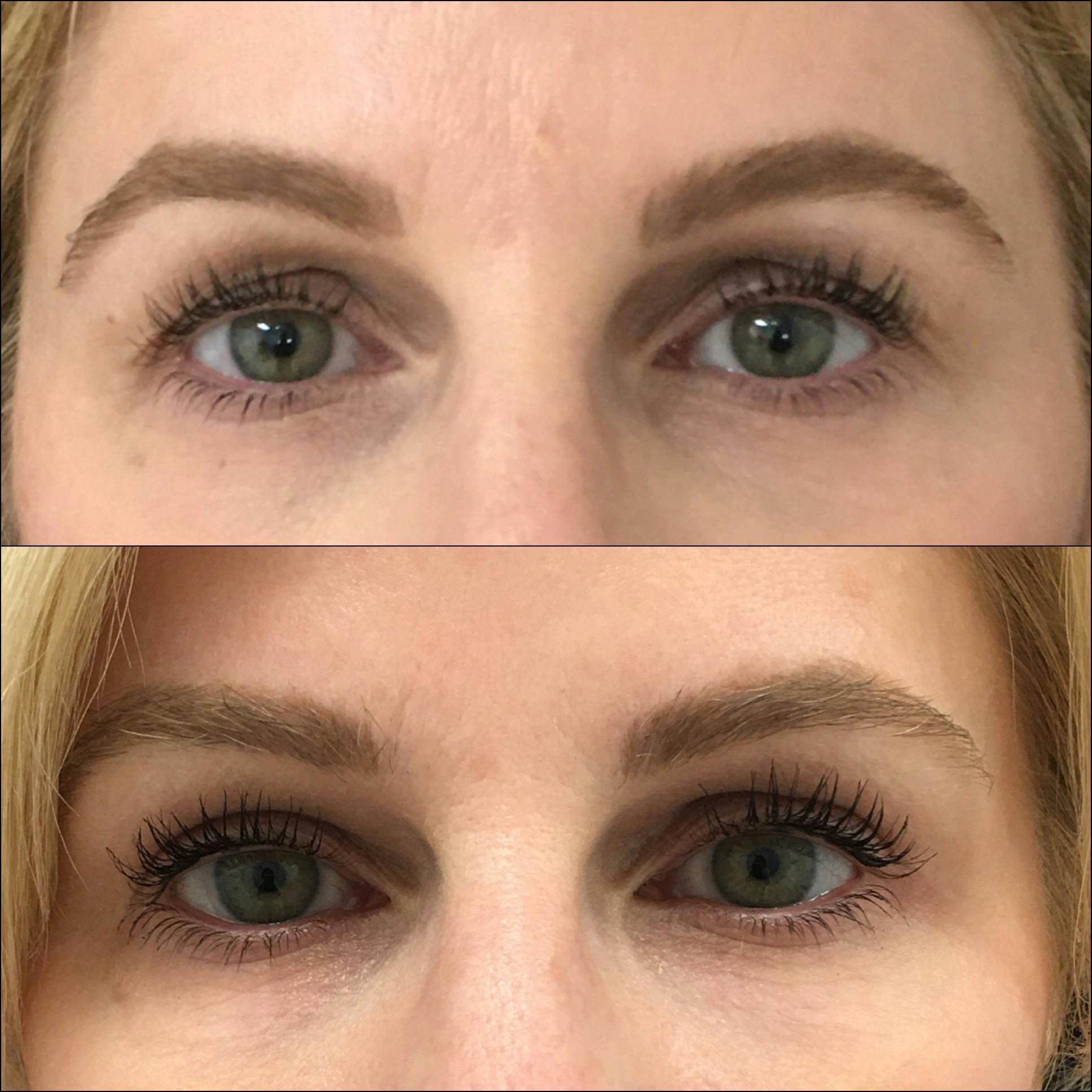 Upper Blepharoplasty Before & After Gallery - Patient 56142588 - Image 1