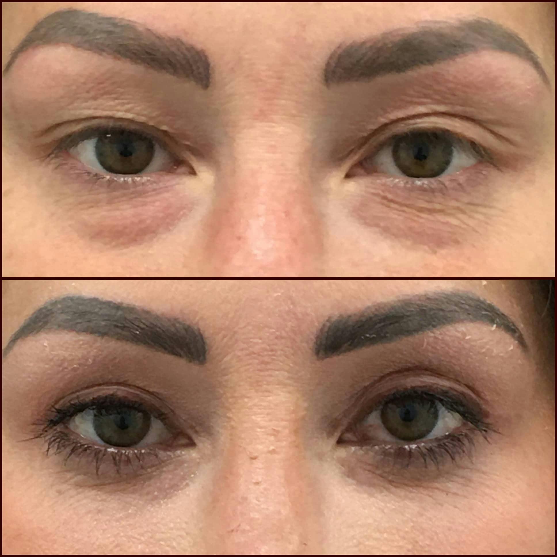 Upper & Lower Blepharoplasty Before & After Gallery - Patient 132753941 - Image 1