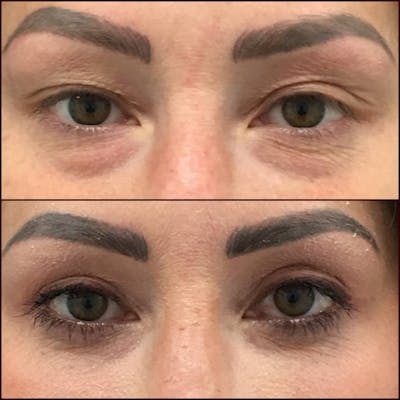 Upper Blepharoplasty Before & After Gallery - Patient 132754045 - Image 1