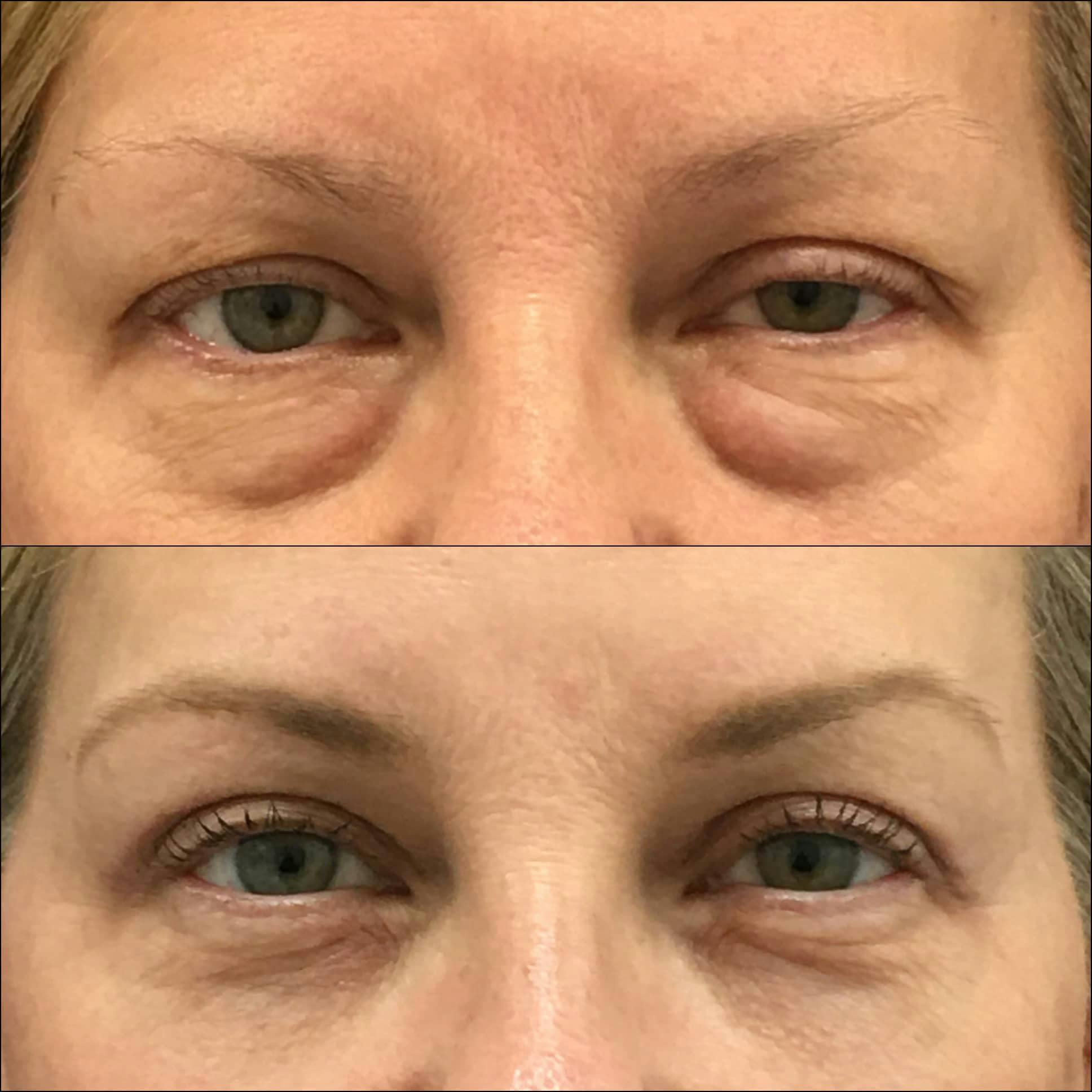 Upper & Lower Blepharoplasty Before & After Gallery - Patient 132755576 - Image 1