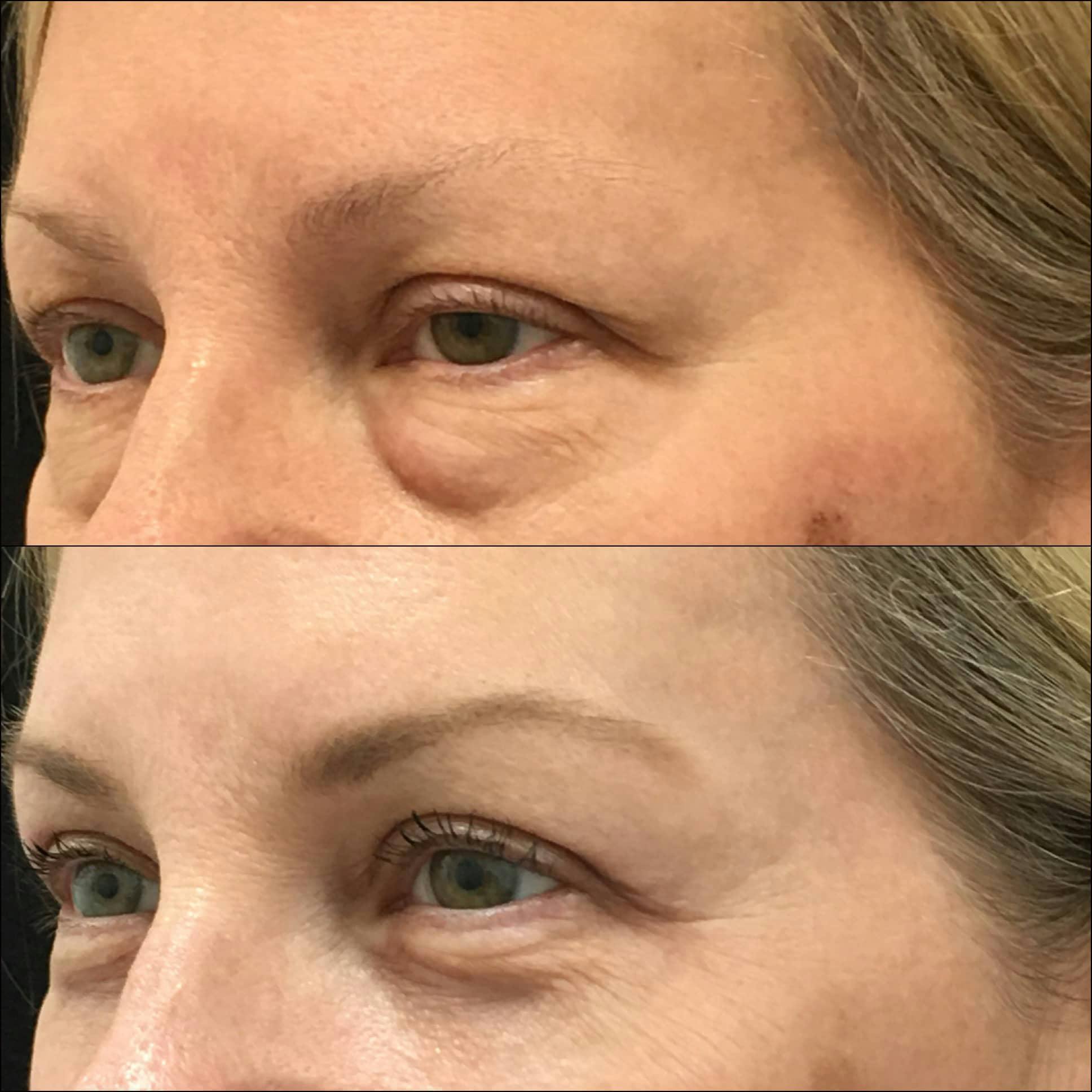 Upper & Lower Blepharoplasty Before & After Gallery - Patient 132755576 - Image 2