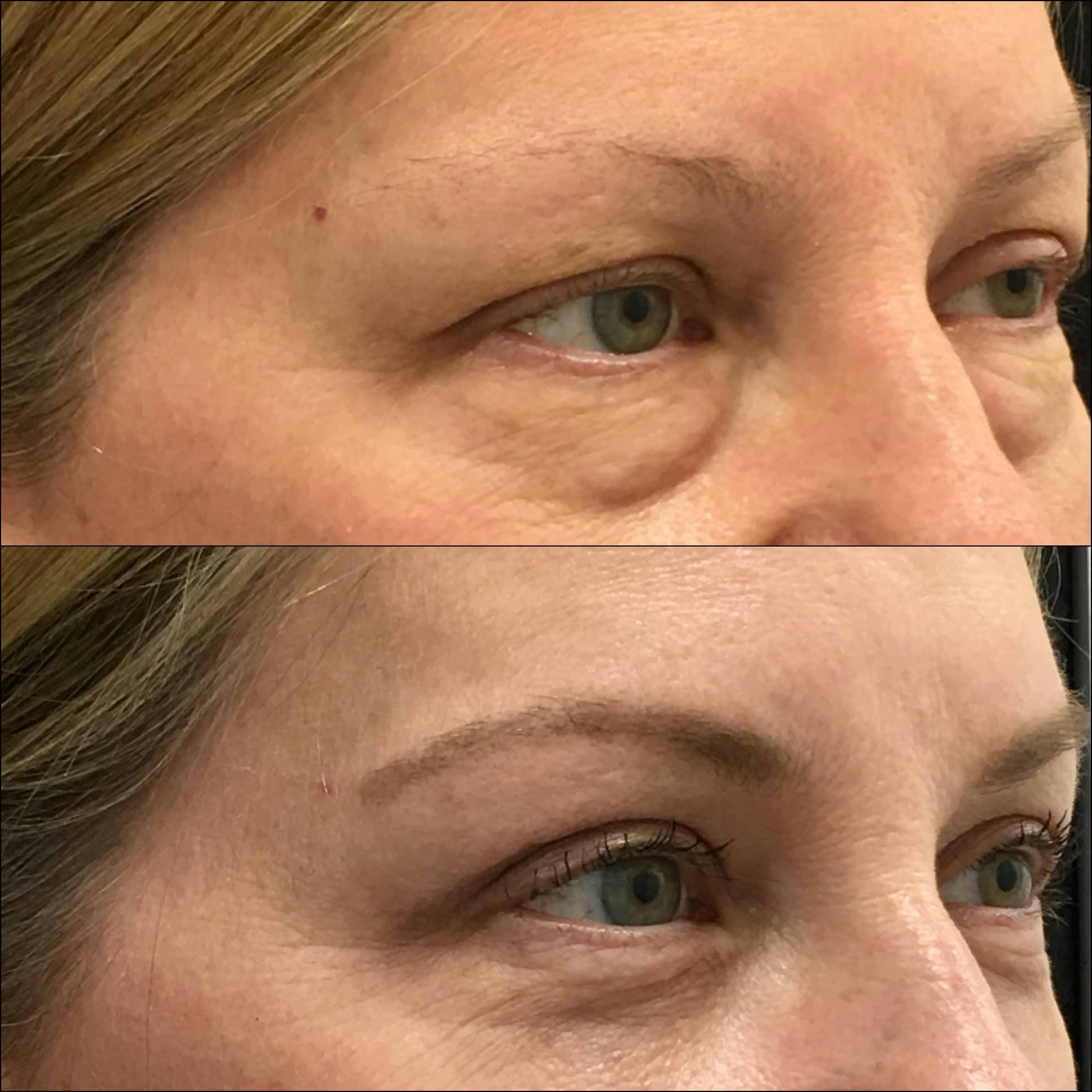 Upper & Lower Blepharoplasty Before & After Gallery - Patient 132755576 - Image 3