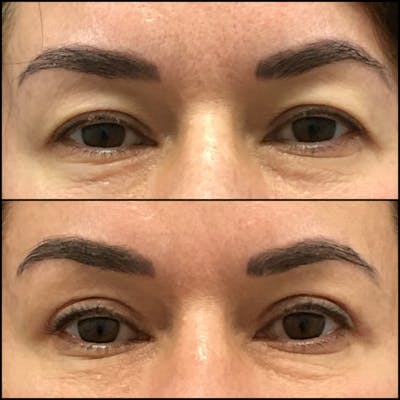 Upper Blepharoplasty Before & After Gallery - Patient 132904149 - Image 1