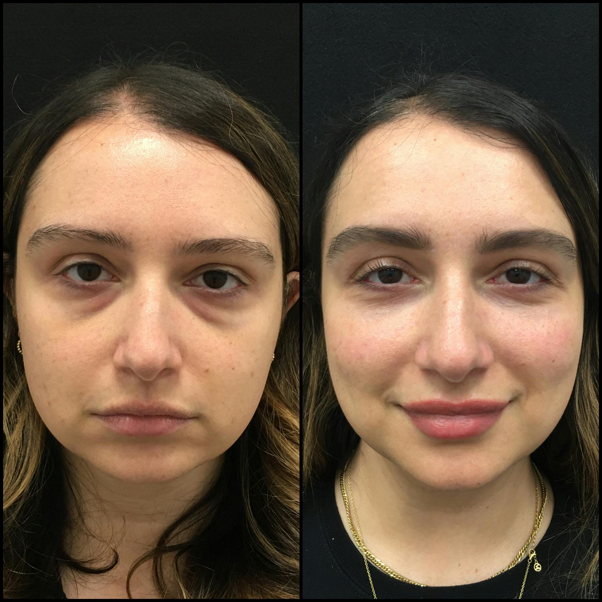 Lower Blepharoplasty Before & After Gallery - Patient 141228577 - Image 1