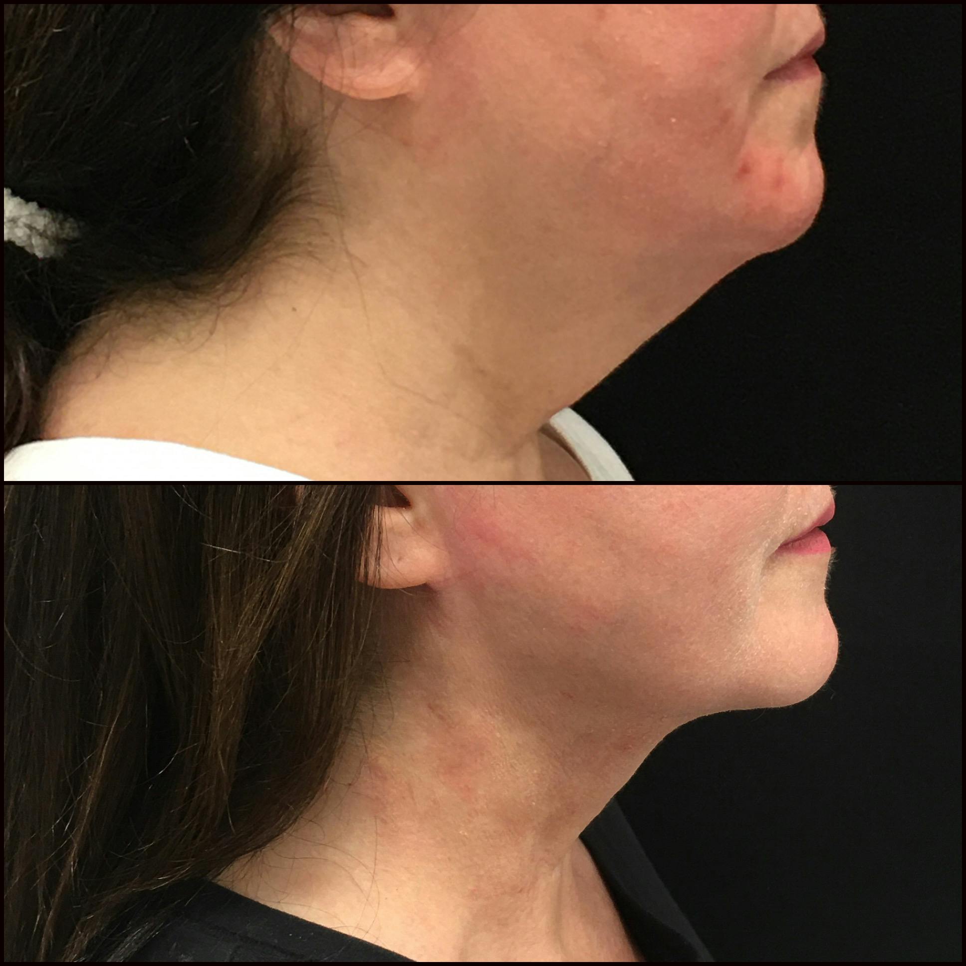 Submental Liposuction Before & After Gallery - Patient 141228617 - Image 1