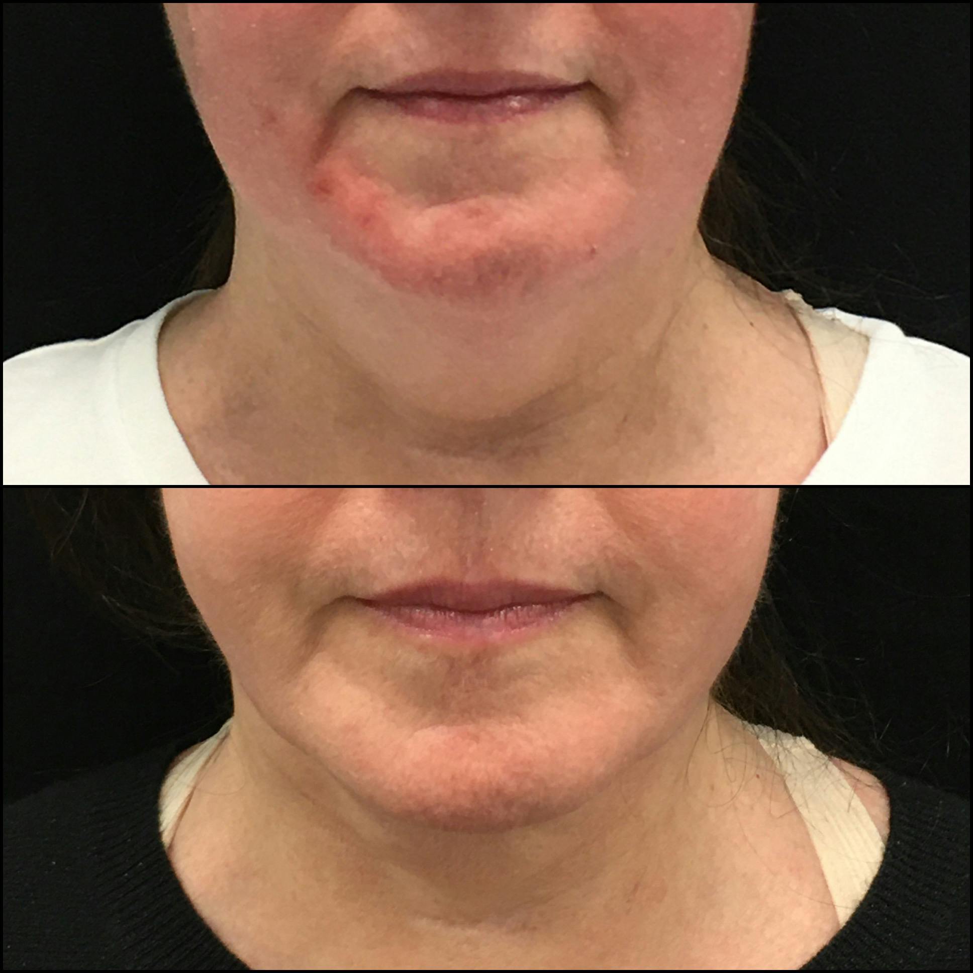 Submental Liposuction Before & After Gallery - Patient 141228617 - Image 5