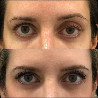 Ptosis Repair Before & After Gallery - Patient 142706441 - Image 1