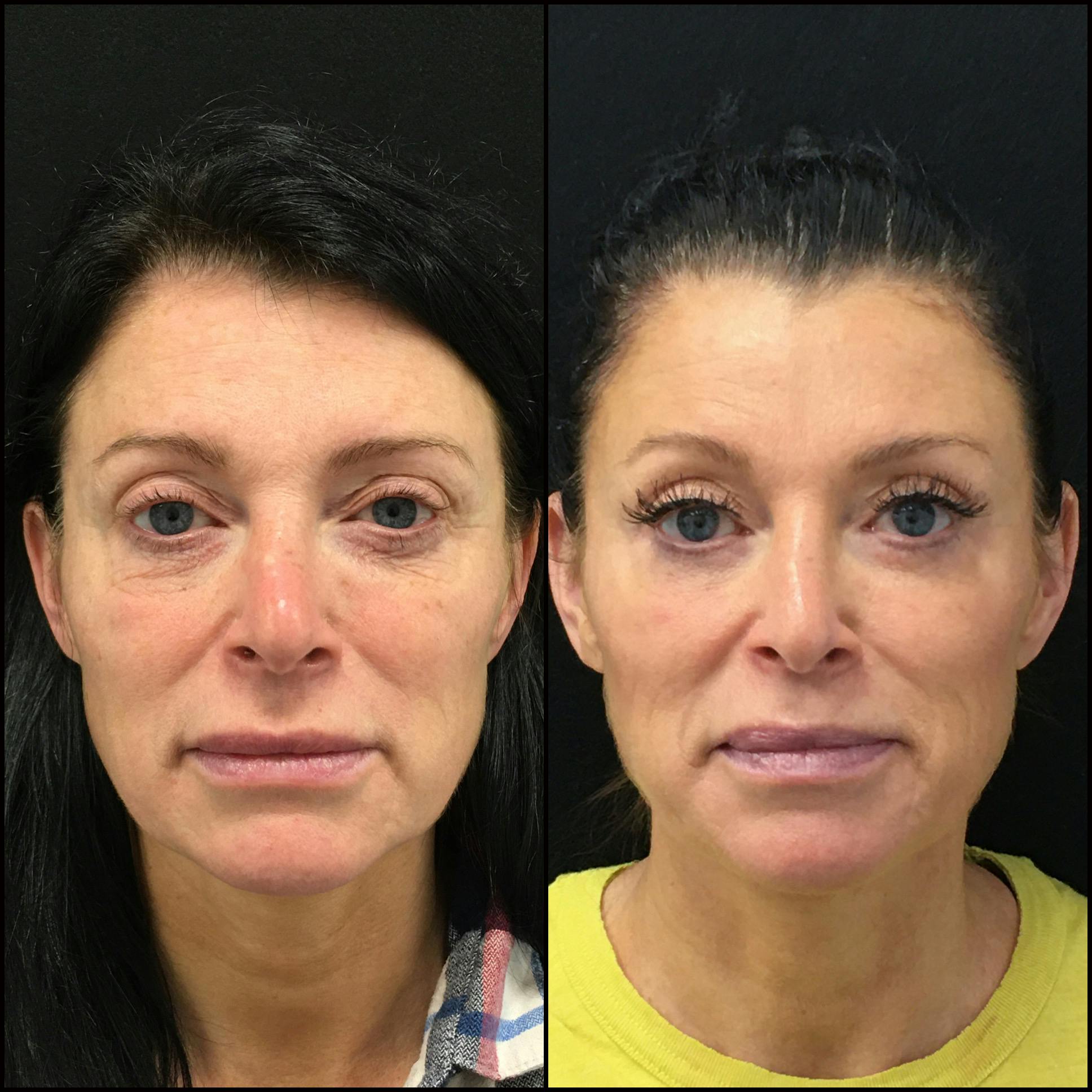 Lower Blepharoplasty Before & After Photos  Flora Levin MD
