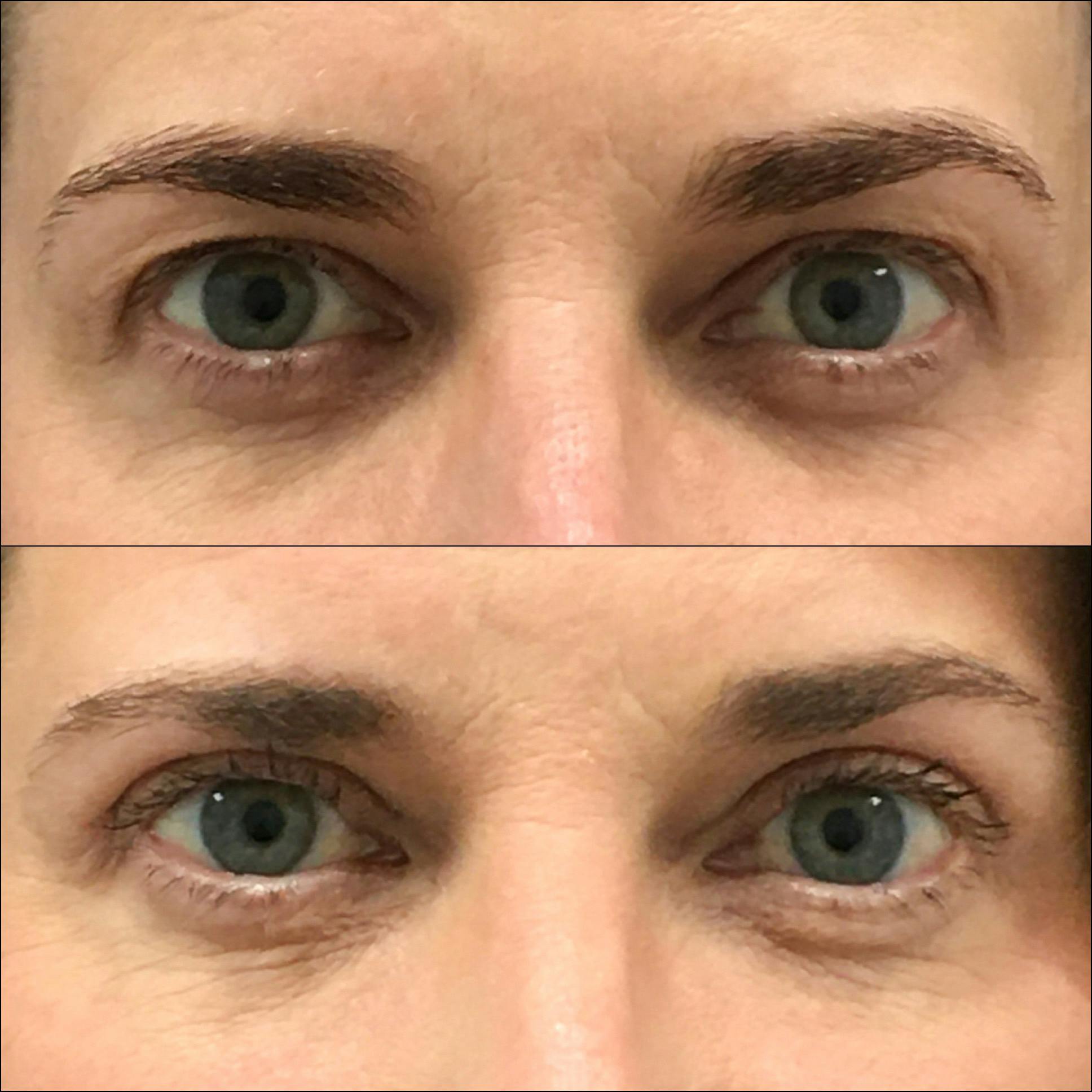 Upper Blepharoplasty Before & After Gallery - Patient 144271102 - Image 1