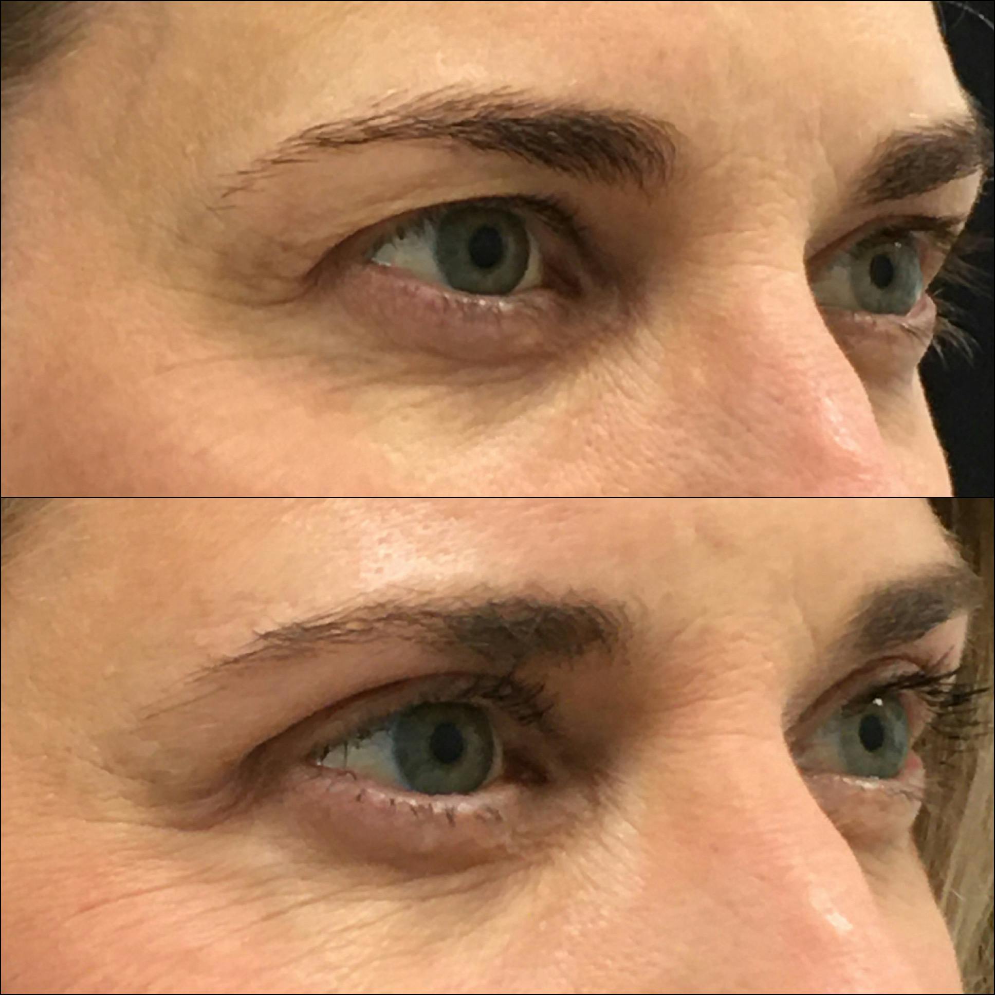 Upper Blepharoplasty Before & After Gallery - Patient 144271102 - Image 2