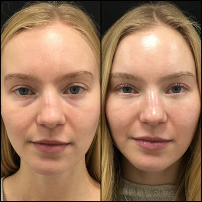 Lower Blepharoplasty Before & After Gallery - Patient 144318334 - Image 1
