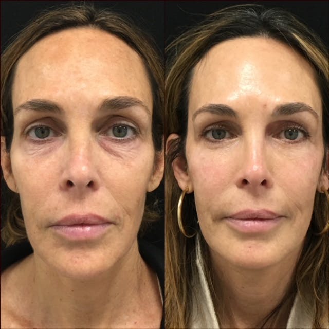Lower Blepharoplasty Before & After Gallery - Patient 146648613 - Image 1