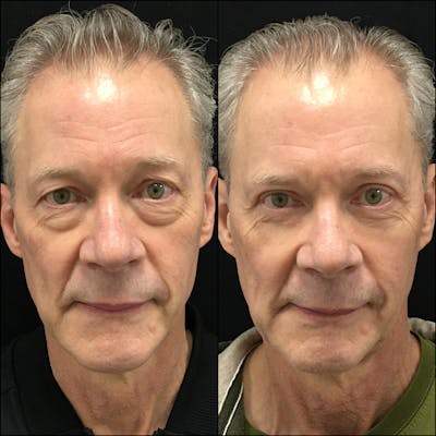 Upper & Lower Blepharoplasty Before & After Gallery - Patient 146669598 - Image 1