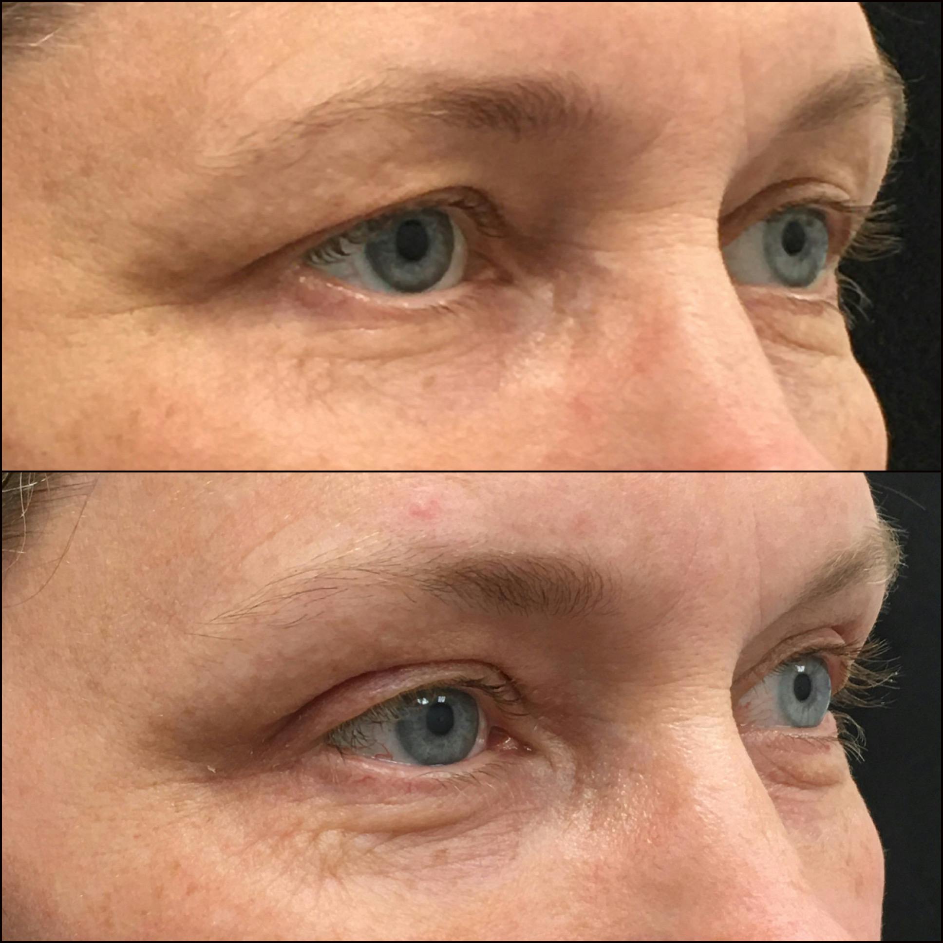 Brow Lift Before & After Gallery - Patient 148313778 - Image 1