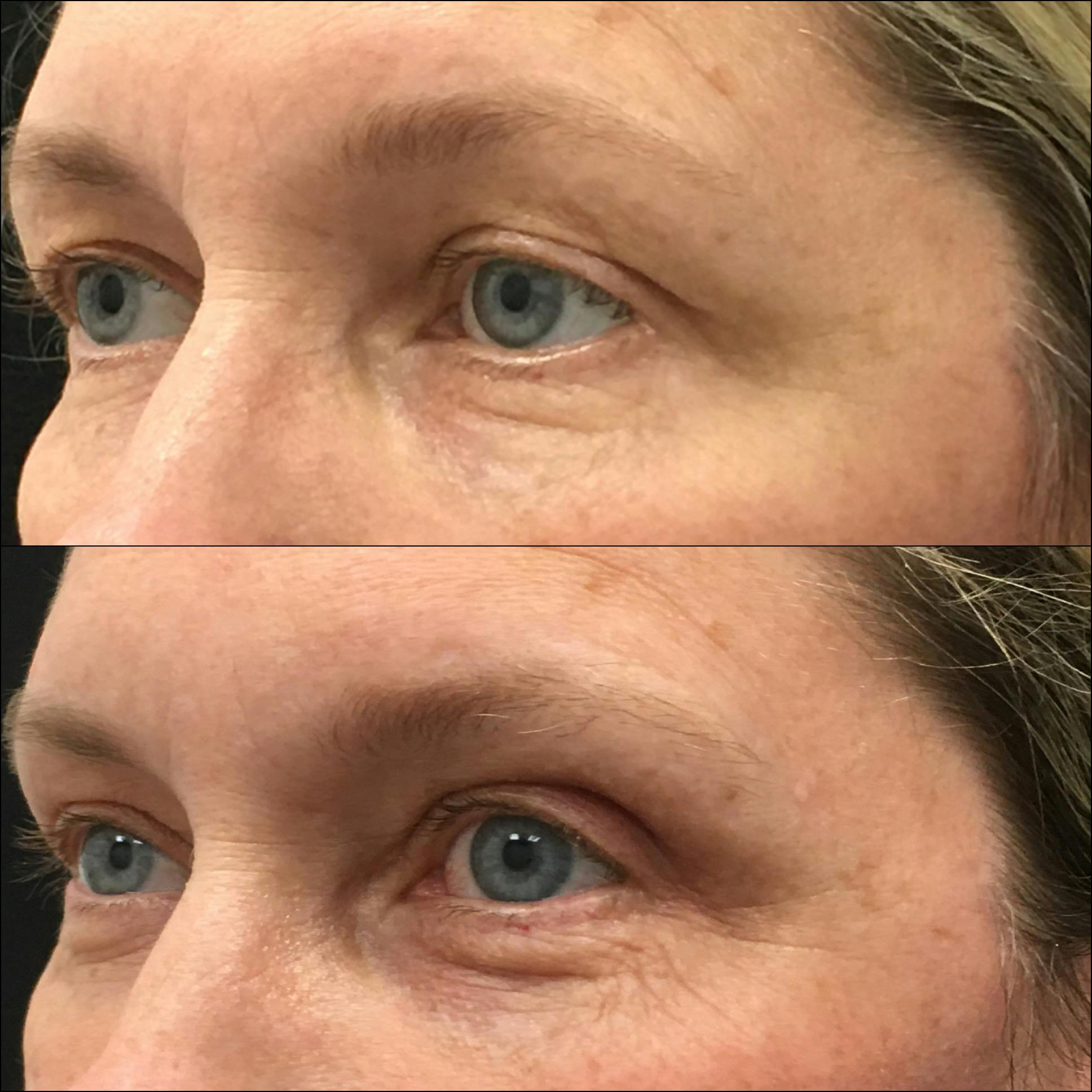 Brow Lift Before & After Gallery - Patient 148313778 - Image 2