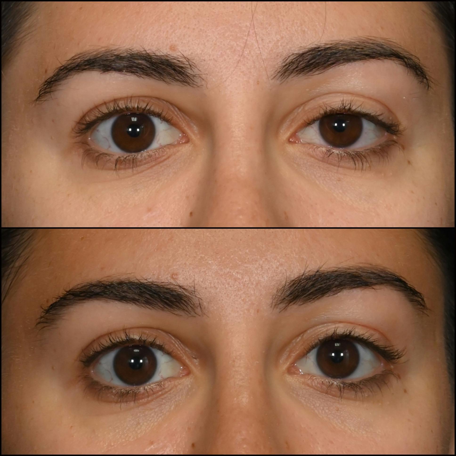 Ptosis Repair Before & After Gallery - Patient 162612876 - Image 1