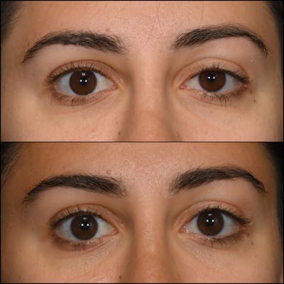 Ptosis Repair Before & After Gallery - Patient 162612876 - Image 1