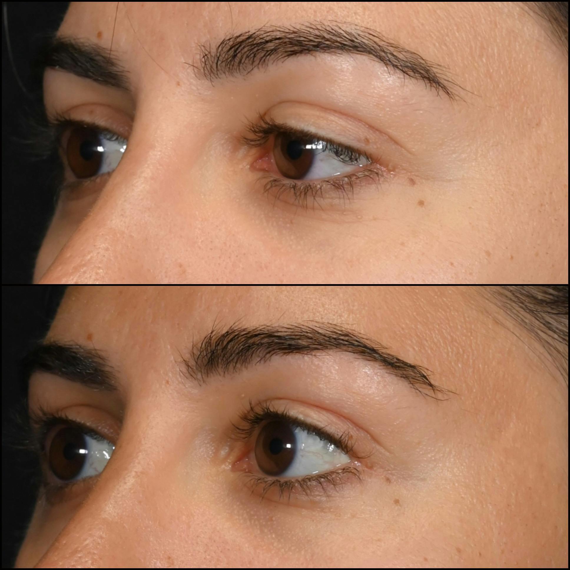 Ptosis Repair Before & After Gallery - Patient 162612876 - Image 2