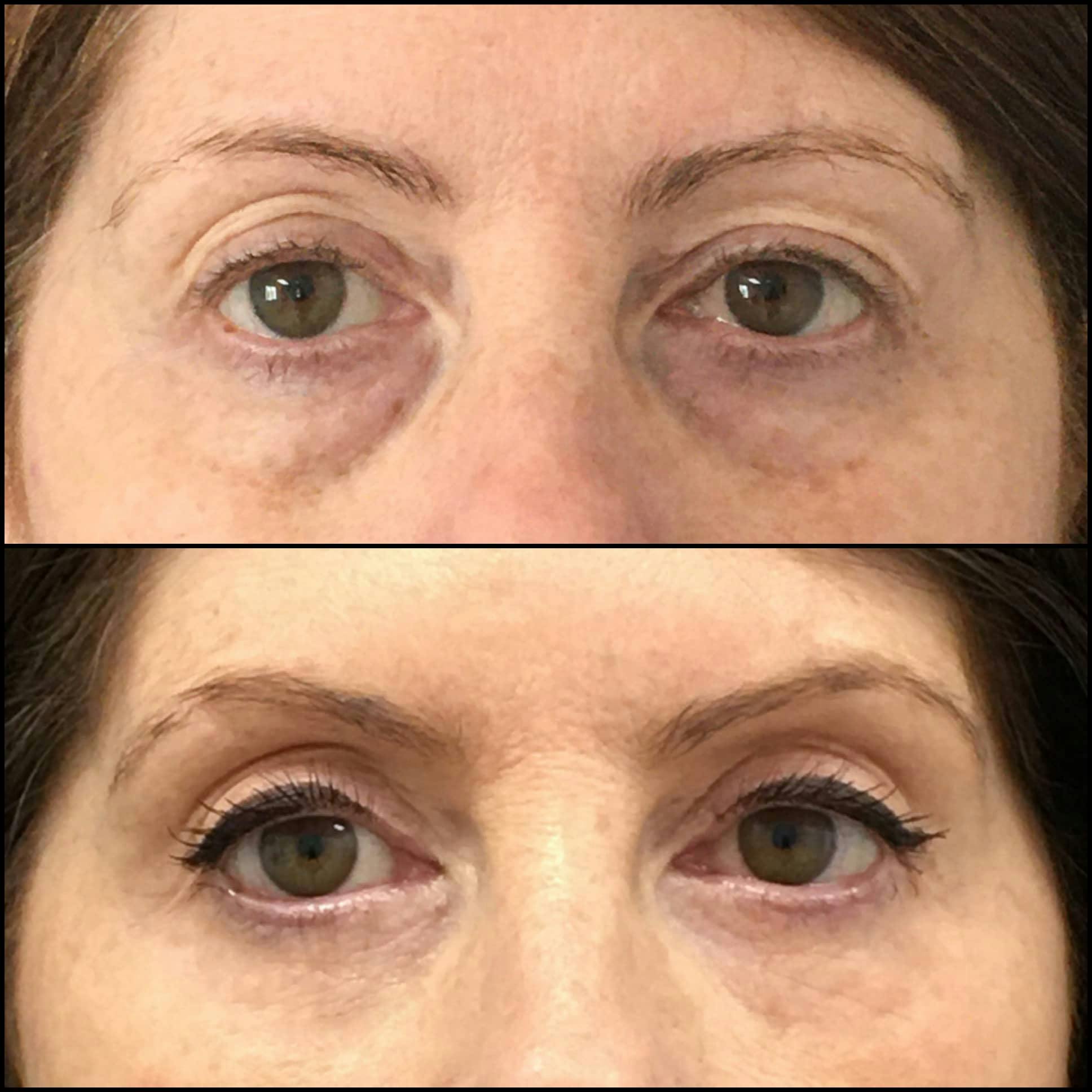 Lower Blepharoplasty Before & After Gallery - Patient 162614092 - Image 1
