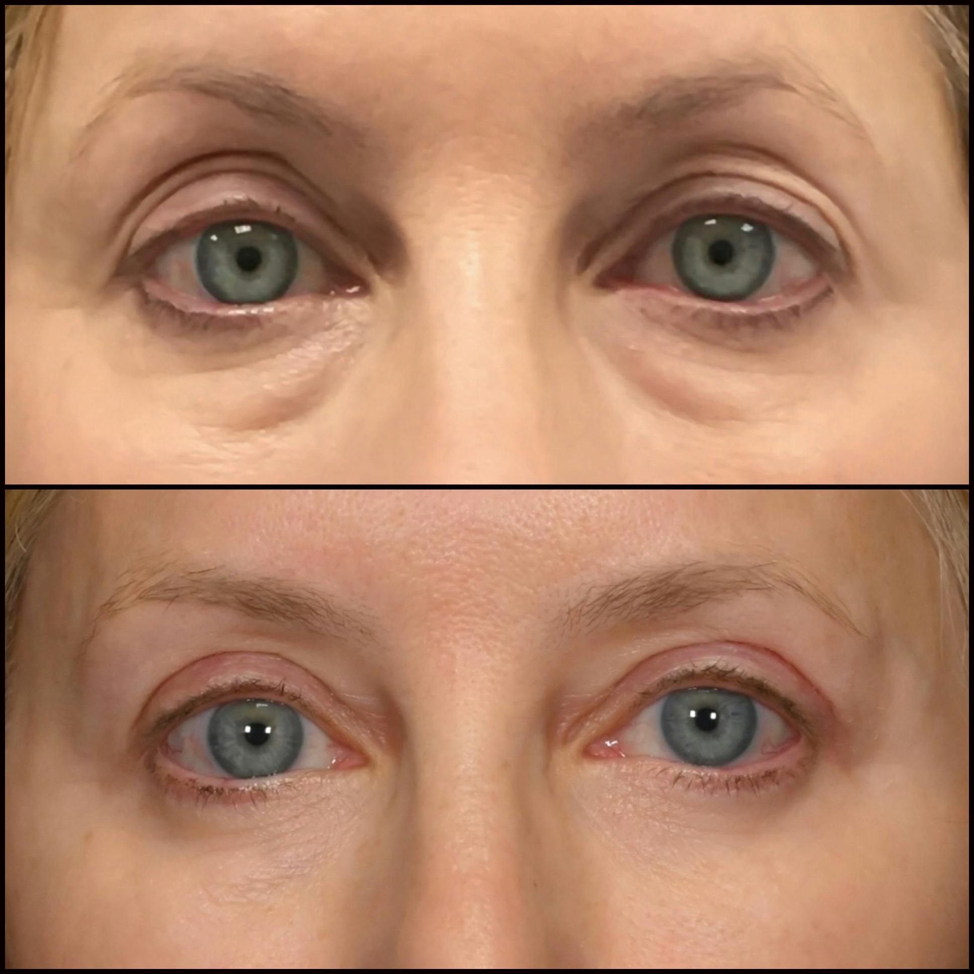 Upper & Lower Blepharoplasty Before & After Gallery - Patient 163042 - Image 1