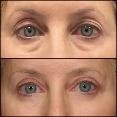 Upper Blepharoplasty Before & After Gallery - Patient 411420 - Image 1