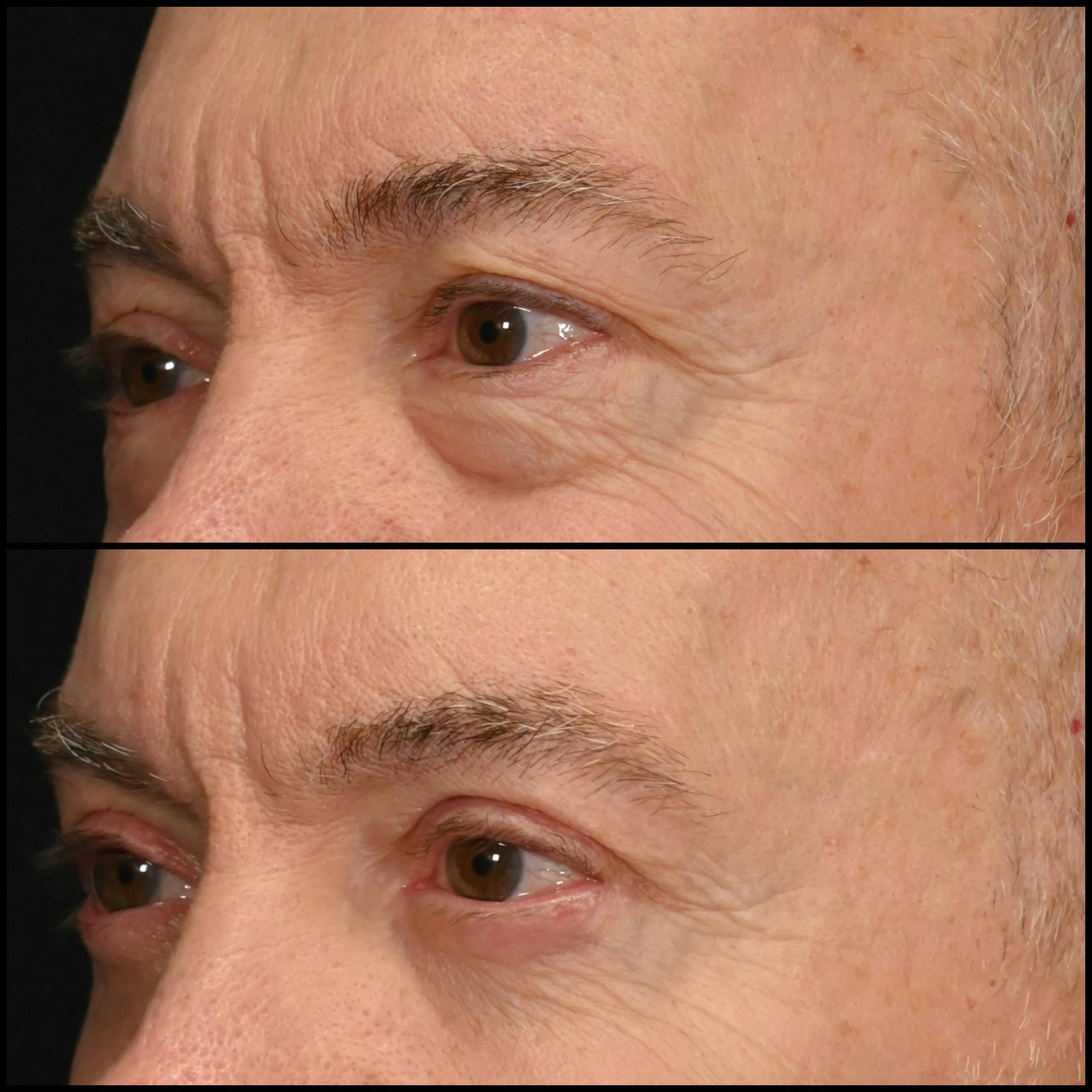 Upper Blepharoplasty Before & After Gallery - Patient 459774 - Image 3