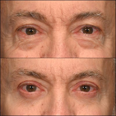 Upper Blepharoplasty Before & After Gallery - Patient 459774 - Image 1