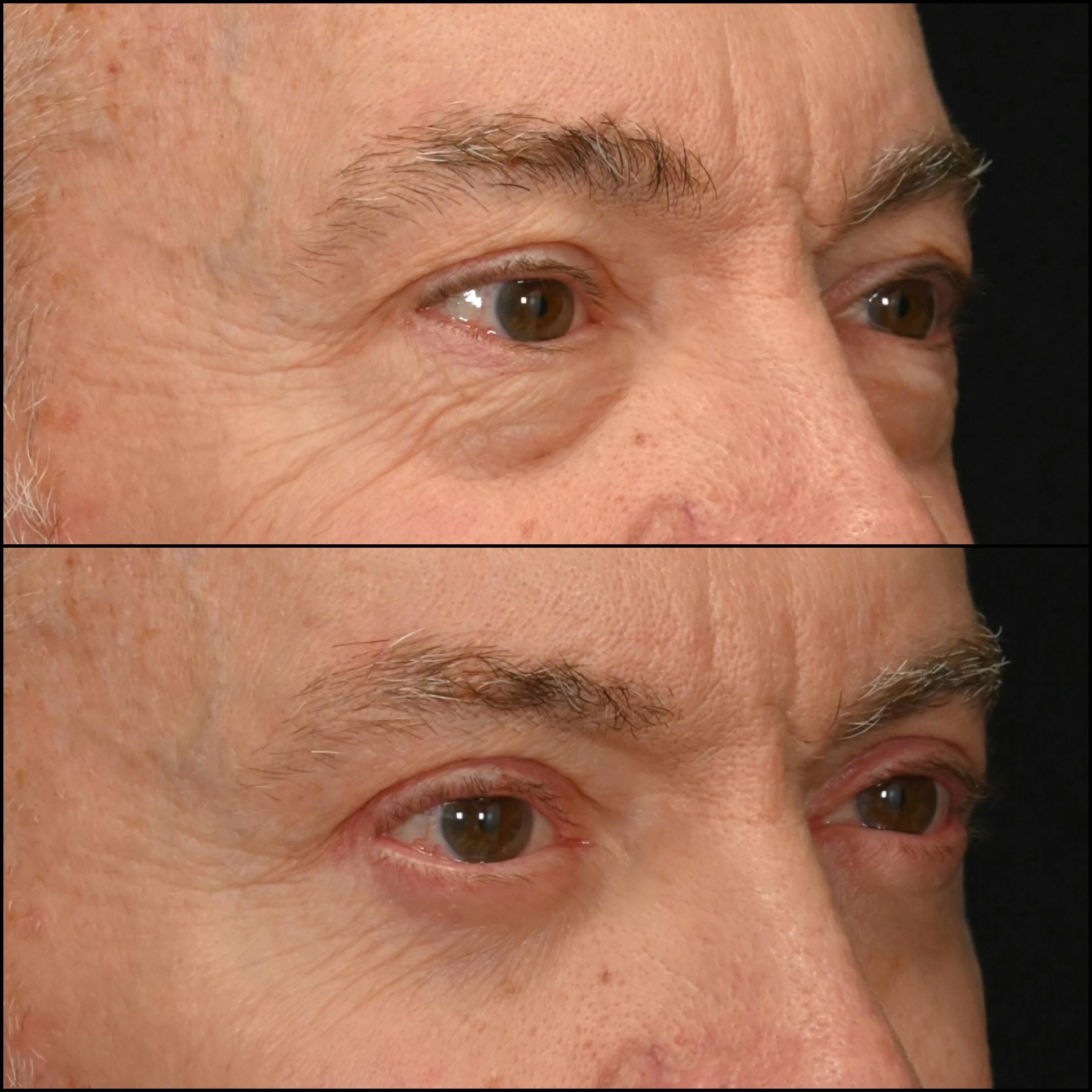 Upper Blepharoplasty Before & After Gallery - Patient 459774 - Image 2