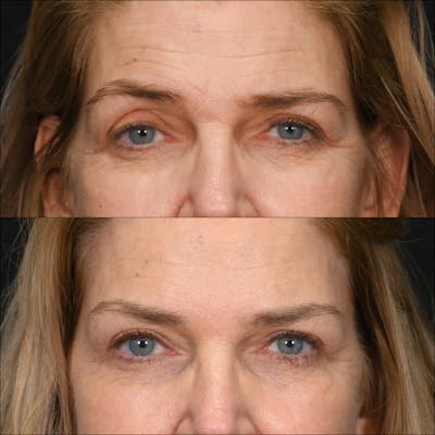 Upper Blepharoplasty Before & After Gallery - Patient 321969 - Image 1