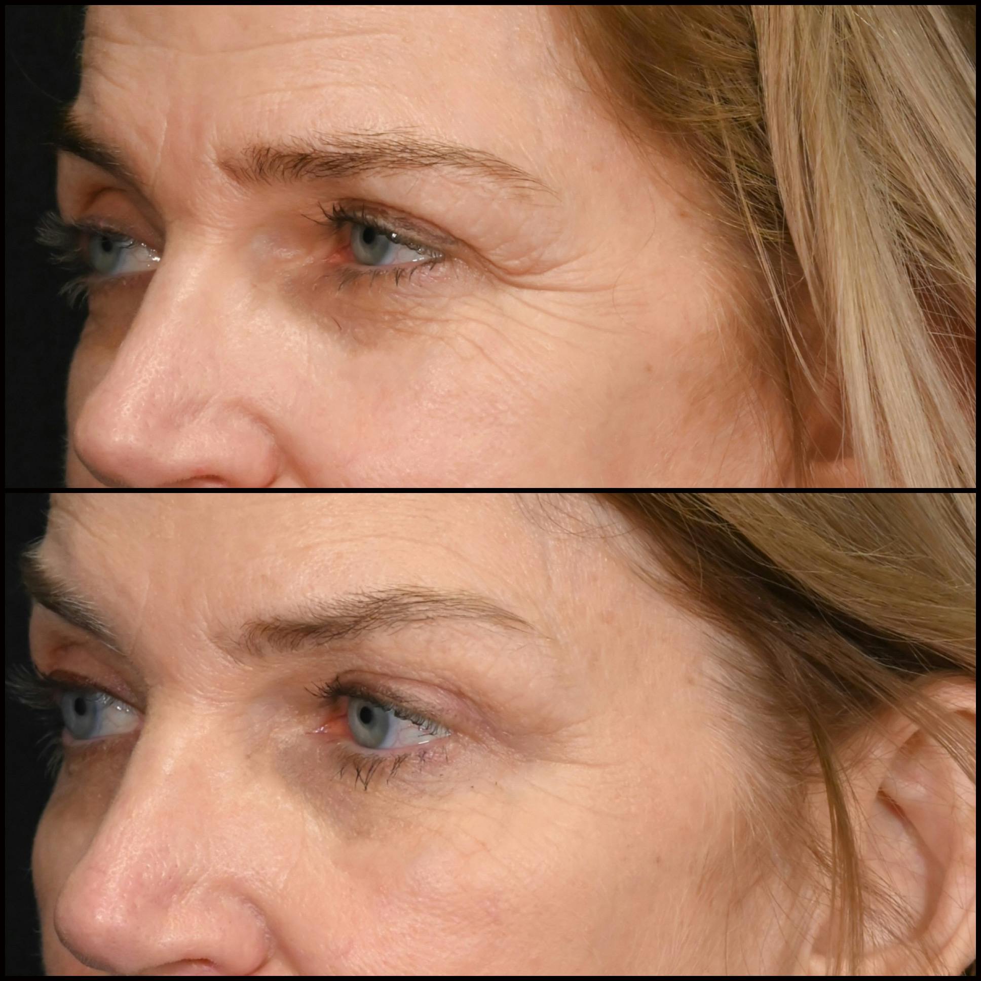 Brow Lift Before & After Gallery - Patient 399073 - Image 3