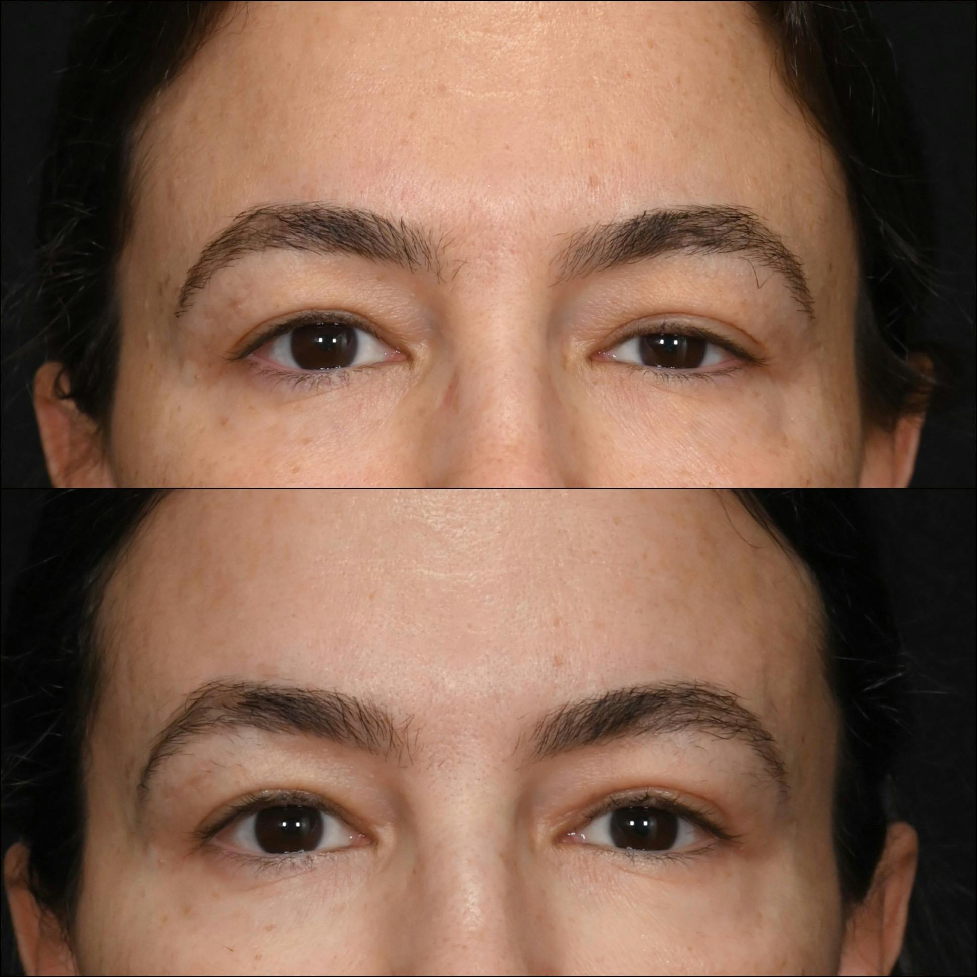Revision Surgery Before & After Gallery - Patient 299147 - Image 1