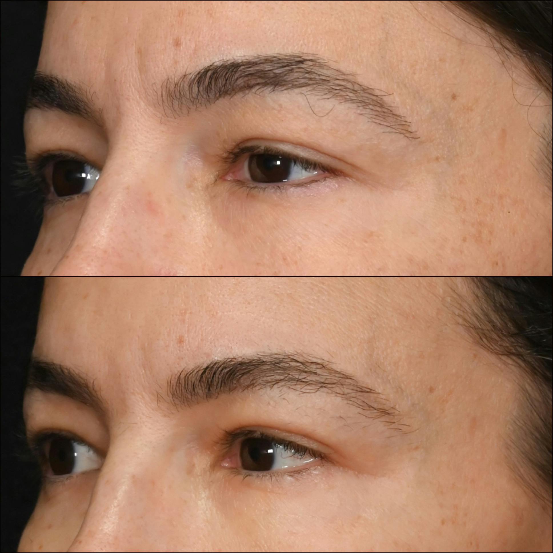 Revision Surgery Before & After Gallery - Patient 299147 - Image 2