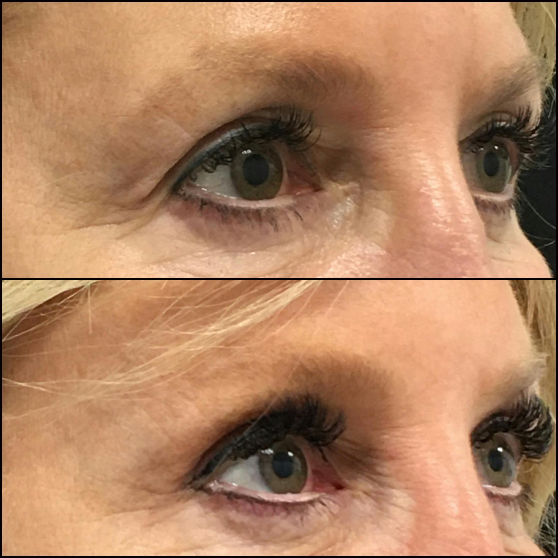 Brow Lift Before & After Gallery - Patient 384725 - Image 1