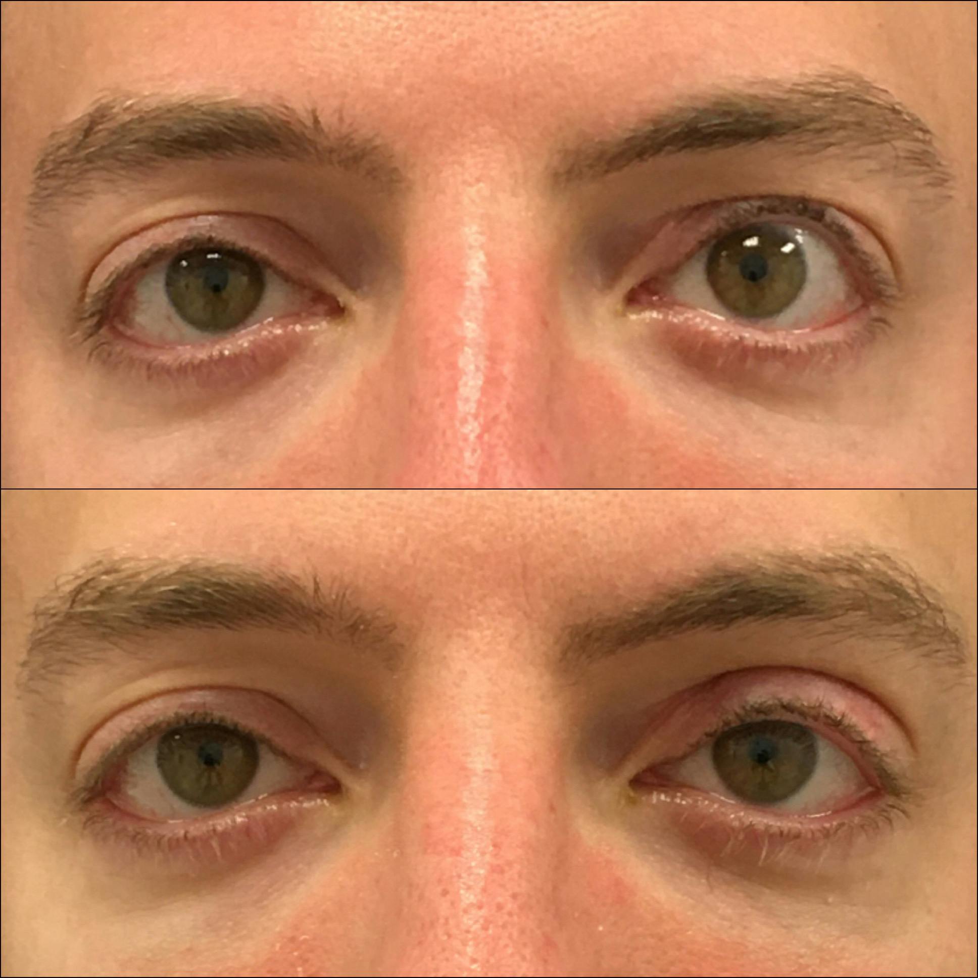 Revision Surgery Before & After Gallery - Patient 149288 - Image 1