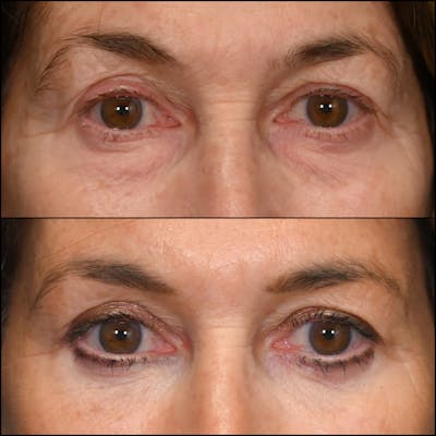 Lower Blepharoplasty Before & After Gallery - Patient 349036 - Image 1