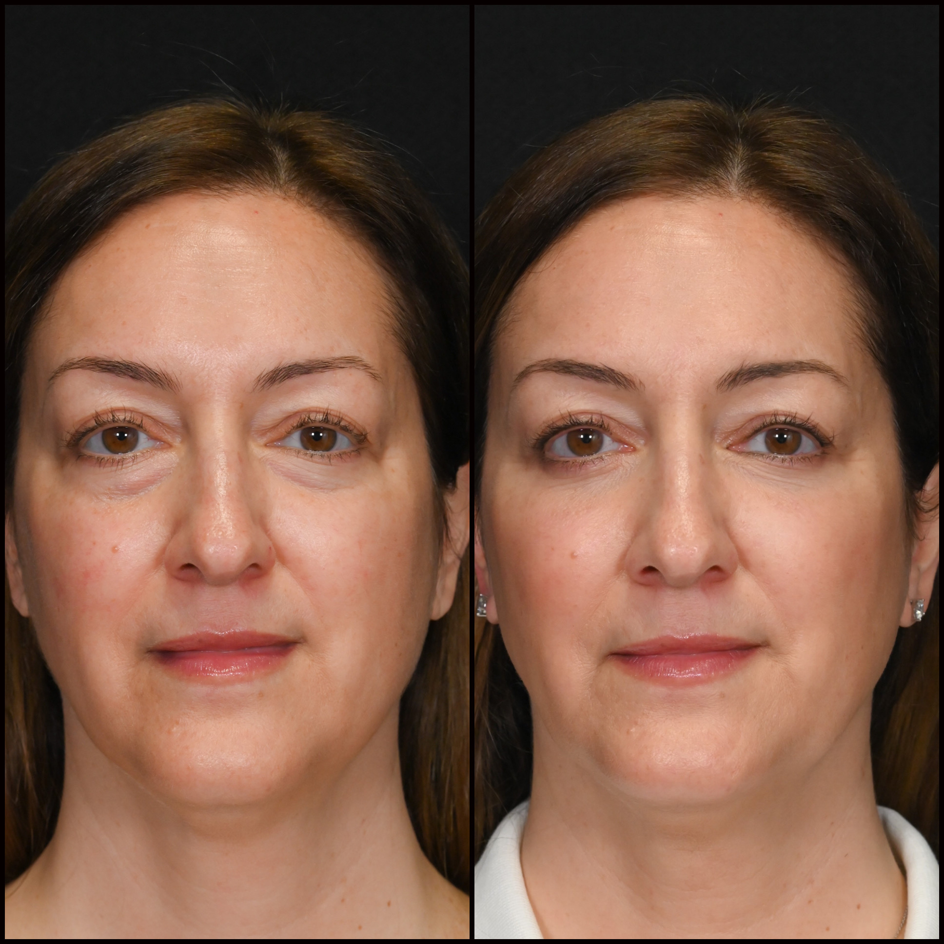 Lower Blepharoplasty Before & After Photos | Flora Levin MD