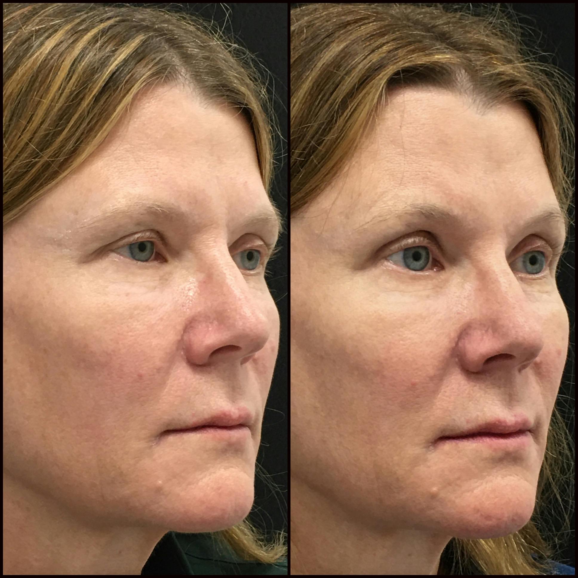 Upper Blepharoplasty Before & After Gallery - Patient 794262 - Image 2