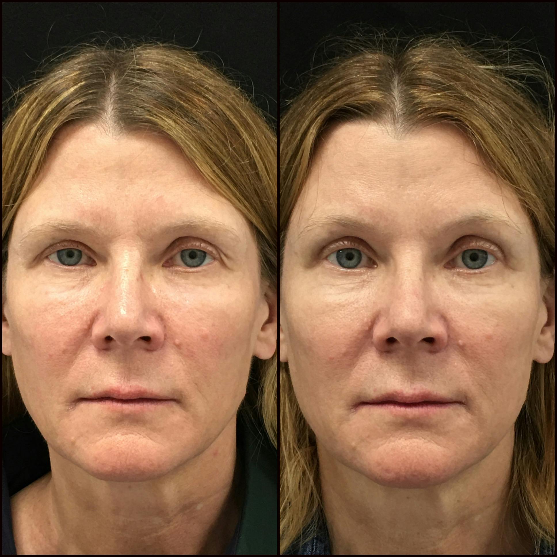 Upper Blepharoplasty Before & After Gallery - Patient 794262 - Image 1