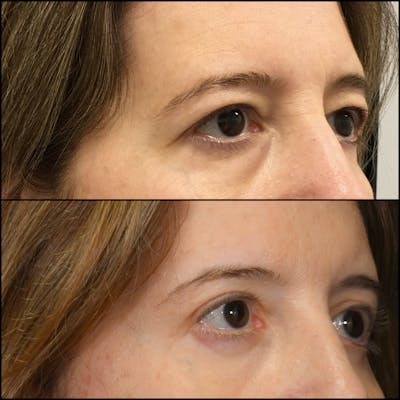Upper Blepharoplasty Before & After Gallery - Patient 312225 - Image 1