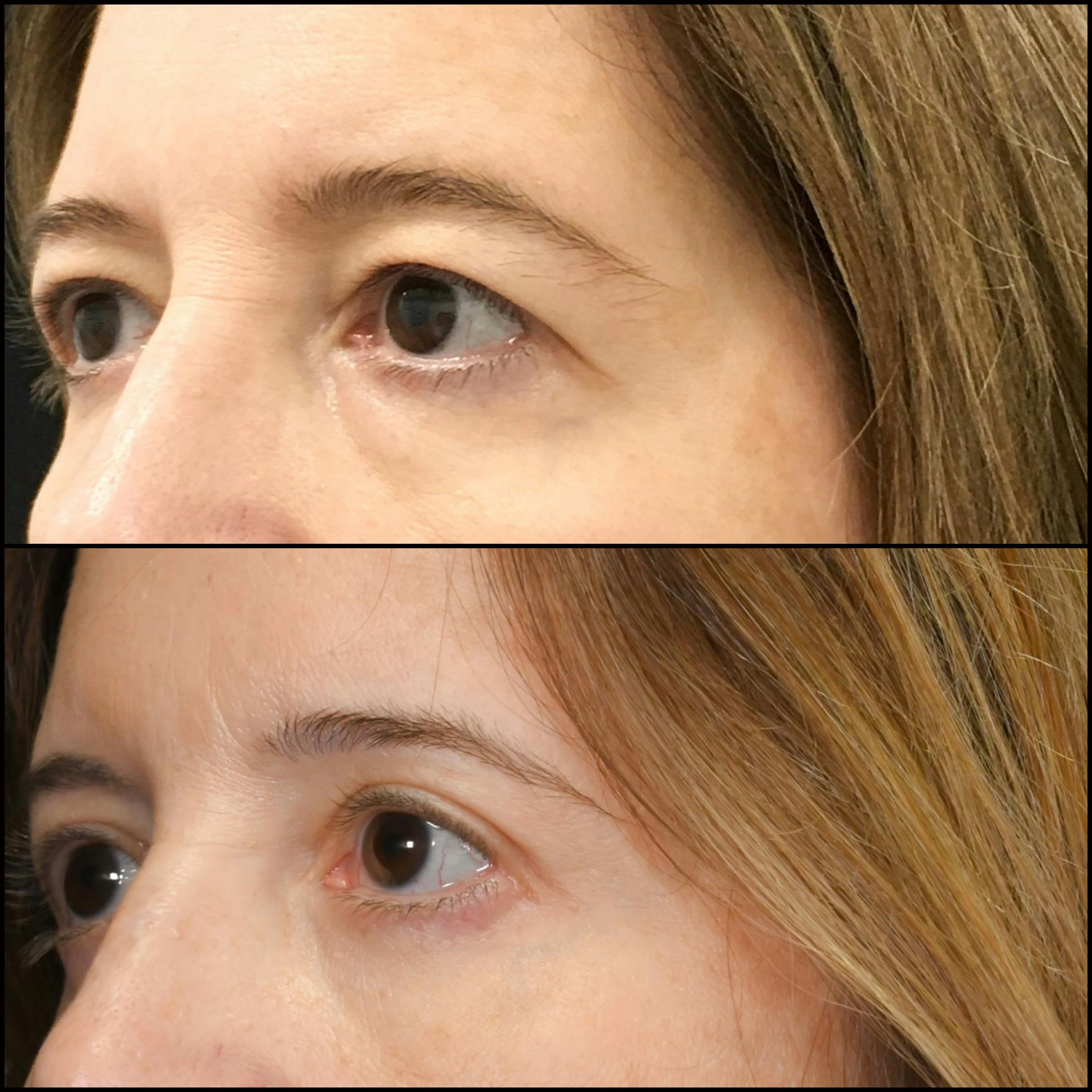 Upper & Lower Blepharoplasty Before & After Gallery - Patient 917573 - Image 2