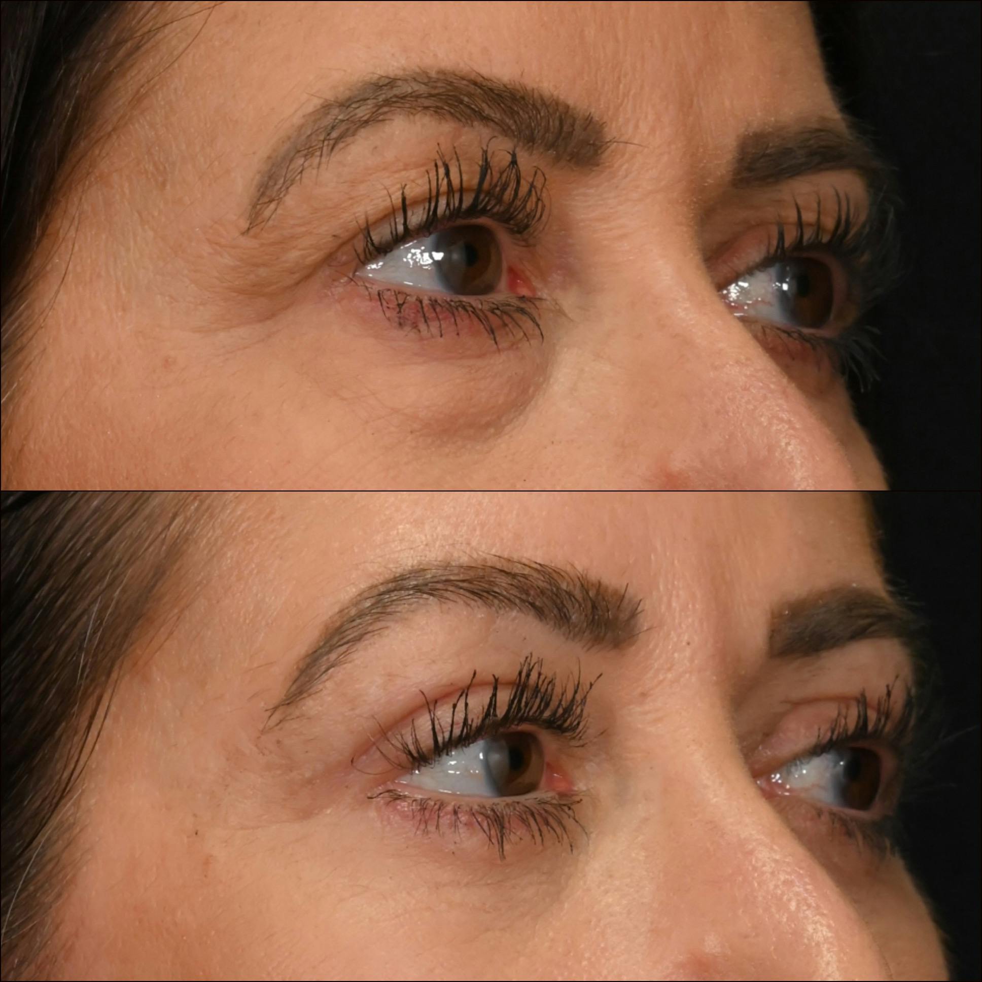 Lower Blepharoplasty Before & After Gallery - Patient 470508 - Image 1