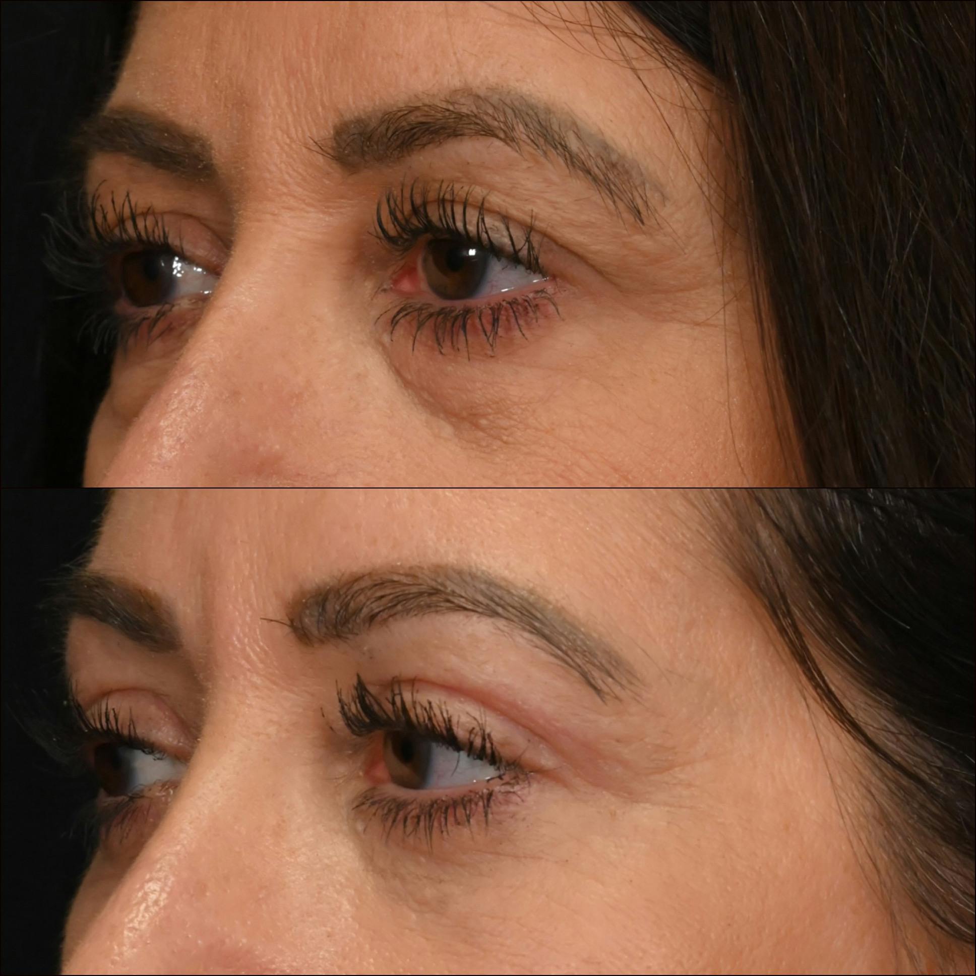 Lower Blepharoplasty Before & After Gallery - Patient 470508 - Image 2