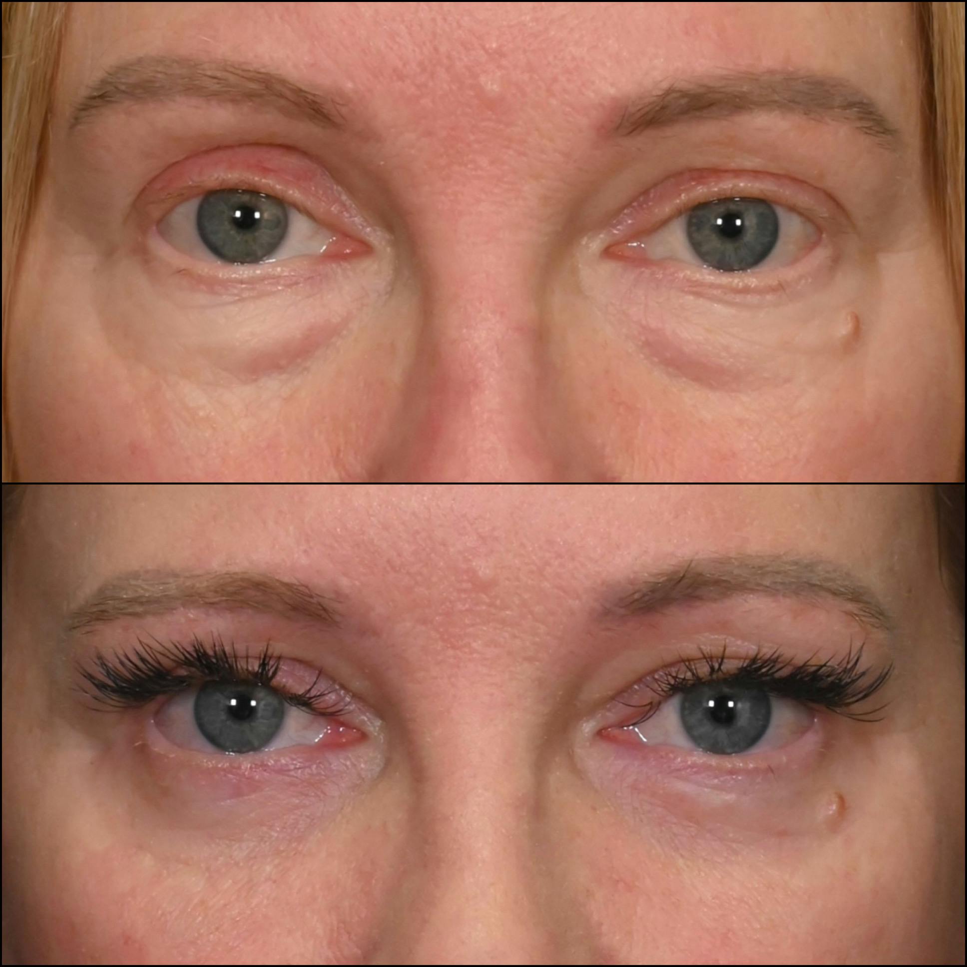 Lower Blepharoplasty Before & After Gallery - Patient 126866 - Image 1