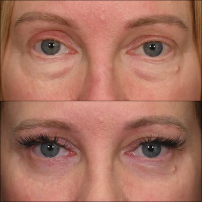 Lower Blepharoplasty Before & After Gallery - Patient 126866 - Image 1