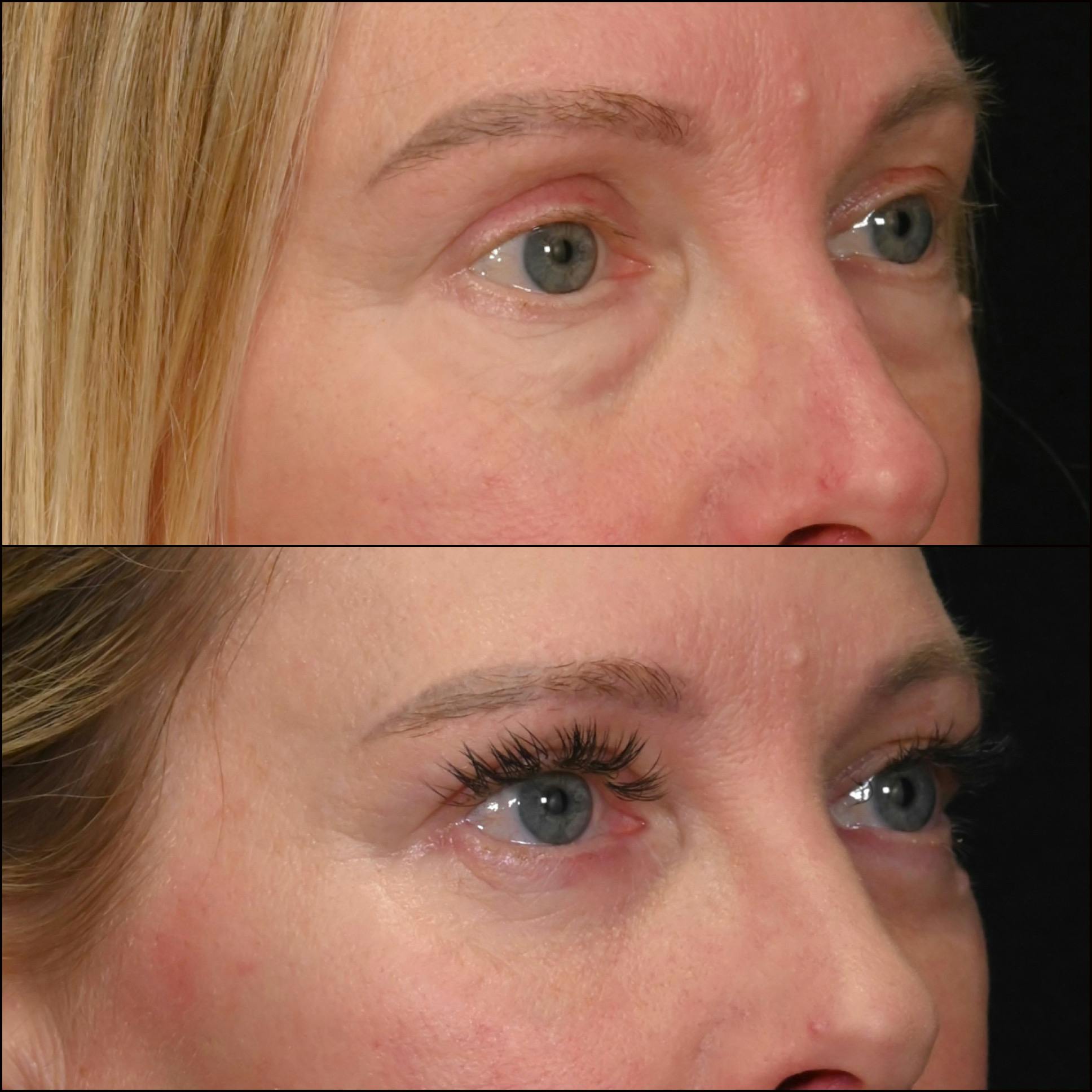 Lower Blepharoplasty Before & After Gallery - Patient 126866 - Image 2