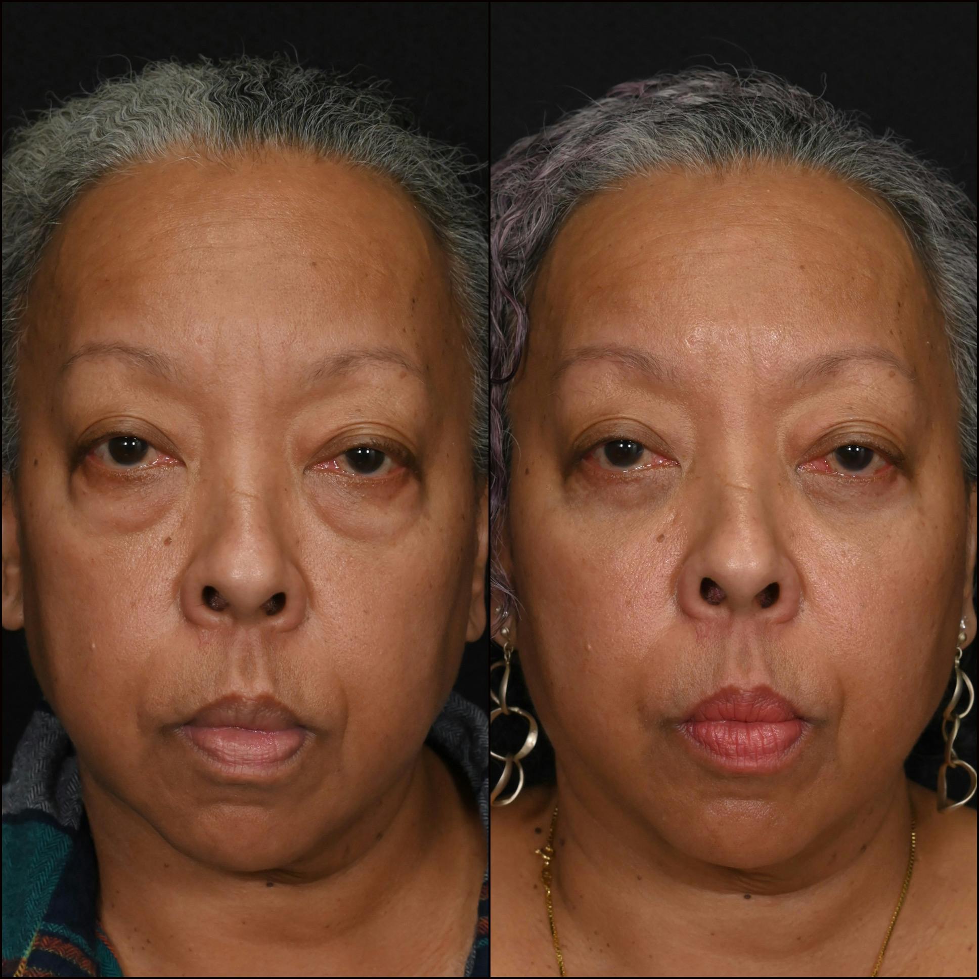 Lower Blepharoplasty Before & After Gallery - Patient 523485 - Image 1