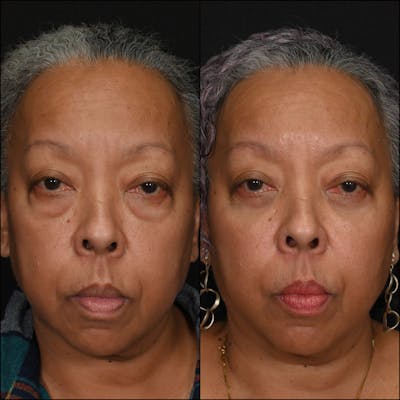 Lower Blepharoplasty Before & After Gallery - Patient 523485 - Image 1