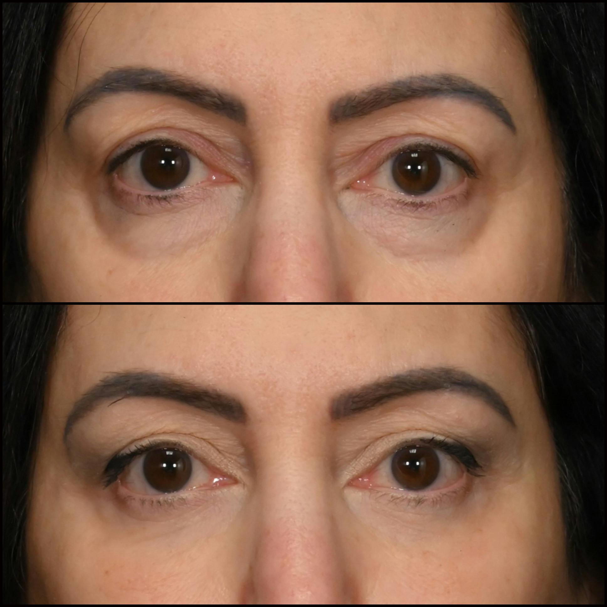 Lower Blepharoplasty Before & After Gallery - Patient 363521 - Image 1