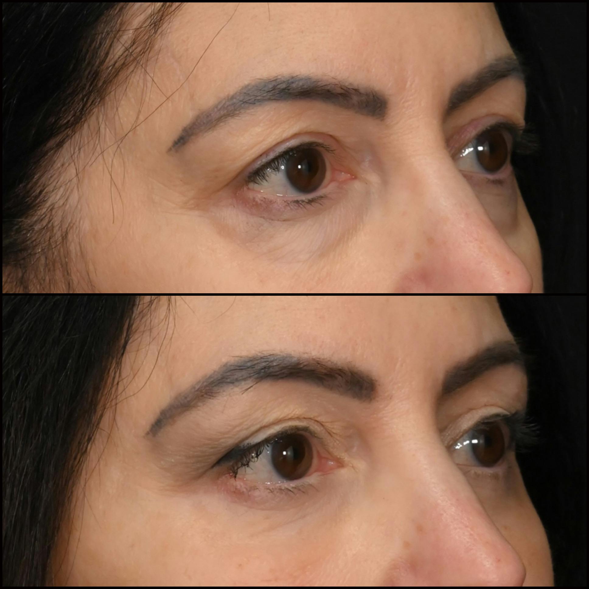 Lower Blepharoplasty Before & After Gallery - Patient 363521 - Image 2